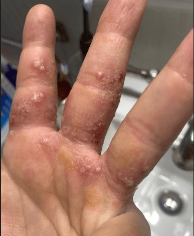 Eczema Jiu Jitsu Staph Thrid Coast Health